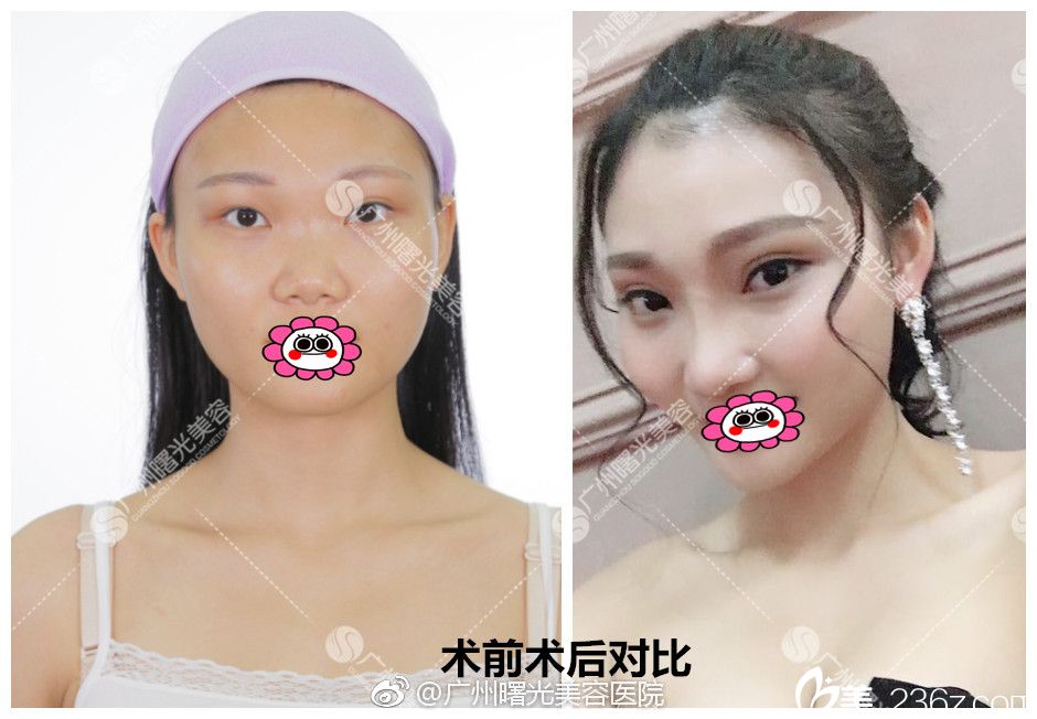 廣州曙光醫(yī)院范丹雙眼皮效果圖