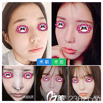 廣州曙光整形醫(yī)院院長鼻部整形變化圖