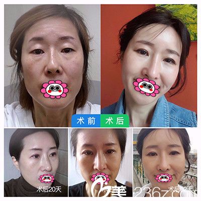 廣州曙光整形醫(yī)院祛眼袋前后對(duì)比圖