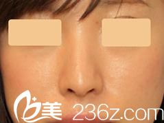 日本口碑好的鼻部修復整形醫(yī)院有哪些?銀座紫羅蘭花美容形成外科醫(yī)院鼻部修復前后對比案例