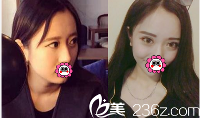 北京藝星<!--<i data=20240703-sp></i>-->謙醫(yī)生雙眼皮案例 北京藝星<!--<i data=20240703-sp></i>-->謙醫(yī)生雙眼皮案例