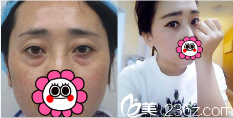 北京藝星<!--<i data=20240703-sp></i>-->謙醫(yī)生祛眼袋案例 北京藝星<!--<i data=20240703-sp></i>-->謙醫(yī)生祛眼袋案例