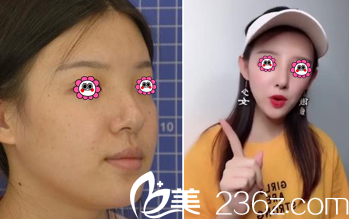 北京藝星陳玉連醫(yī)生耳軟骨復(fù)合隆鼻案例 北京藝星陳玉連醫(yī)生耳軟骨復(fù)合隆鼻案例