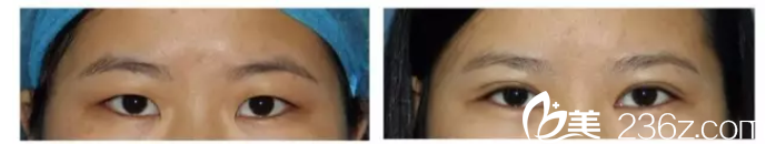 北京藝星李帥華醫(yī)生內(nèi)眥贅皮矯正案例 北京藝星李帥華醫(yī)生內(nèi)眥贅皮矯正案例