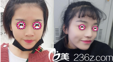 北京藝星李帥華醫(yī)生隆鼻案例 北京藝星李帥華醫(yī)生隆鼻案例