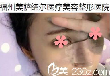 做完膨體加耳軟骨隆鼻第5天 做完膨體加耳軟骨隆鼻第5天