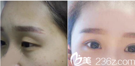 北京藝星晏丹醫(yī)生雙眼皮修復(fù)案例 北京藝星晏丹醫(yī)生雙眼皮修復(fù)案例