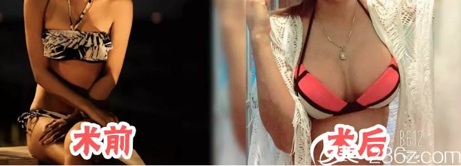 泰國PICHET Rodchareon整形醫(yī)院乳房增大手術(shù)<span style= 泰國PICHET Rodchareon整形醫(yī)院乳房增大手術(shù)<span style=