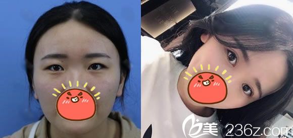 寧波美萊醫(yī)院陳富旺雙眼皮開眼角案例