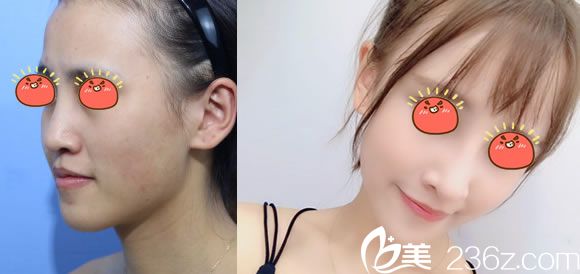 寧波美萊陳富旺鼻綜合隆鼻案例