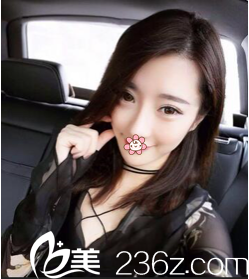 1年前在國內(nèi)做的埋線雙眼皮兩只眼睛不對稱了，所以我去了韓國GIO整形車知勳那兒做雙眼皮失敗修復(fù)！