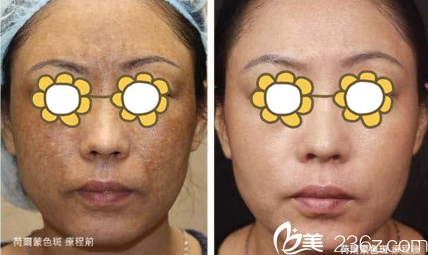 PicoSure 755蜂巢皮秒激光療程治療前后對(duì)比圖 PicoSure 755蜂巢皮秒激光療程治療前后對(duì)比圖