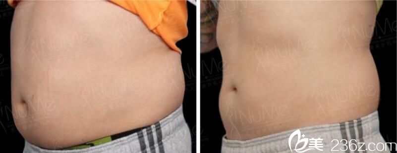 香港NuMe醫(yī)美非侵入性激光溶脂塑身<span style= 香港NuMe醫(yī)美非侵入性激光溶脂塑身<span style=