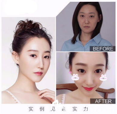 香港FMH醫(yī)學(xué)美容醫(yī)院治療案例 香港FMH醫(yī)學(xué)美容醫(yī)院治療案例