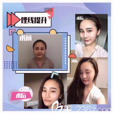 香港FMH醫(yī)學(xué)美容線雕提升真人案例 香港FMH醫(yī)學(xué)美容線雕提升真人案例