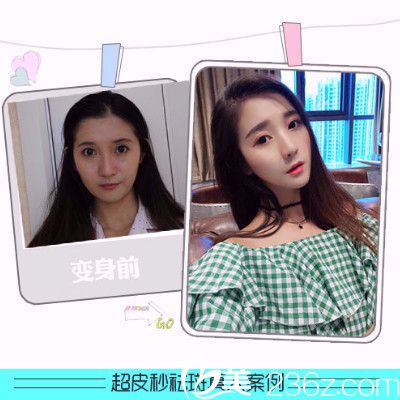 香港FMH醫(yī)學(xué)美容超皮秒祛斑案例 香港FMH醫(yī)學(xué)美容超皮秒祛斑案例