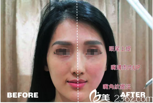 中國臺(tái)灣雅美姬口中鐳射前后對(duì)比案例 中國臺(tái)灣雅美姬口中鐳射前后對(duì)比案例