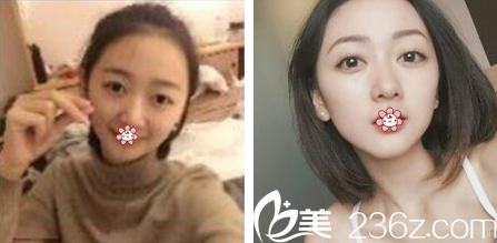 泰國KTOP整形雙眼皮案例