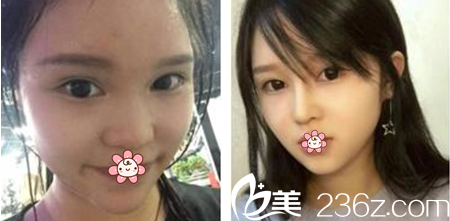 泰國KTOP整形診所怎么樣