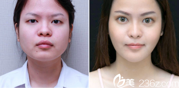 泰國(guó)曼谷F CLINIC醫(yī)美診所V-LINE瓜子臉案例