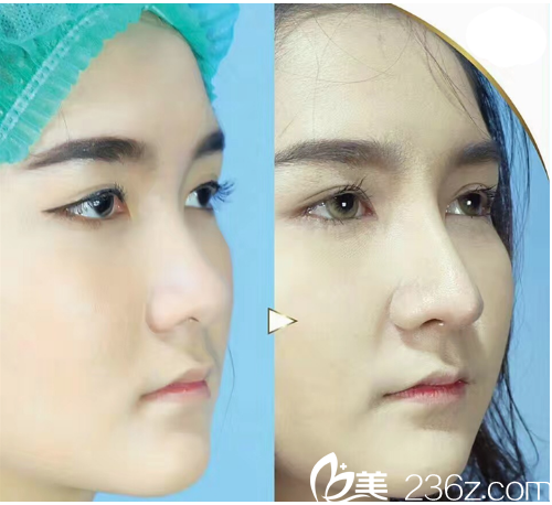 泰國(guó)曼谷F CLINIC醫(yī)美診所薩拉同隆鼻案例