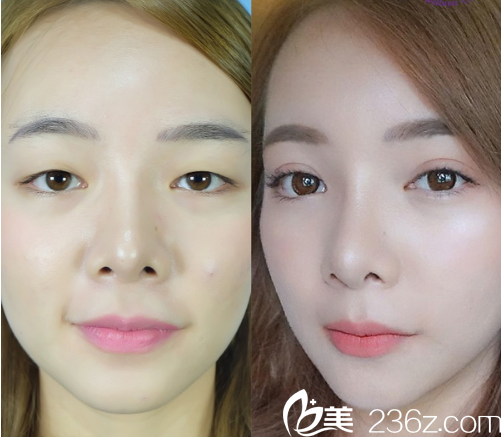 泰國(guó)曼谷F CLINIC醫(yī)美診所雙眼皮案例