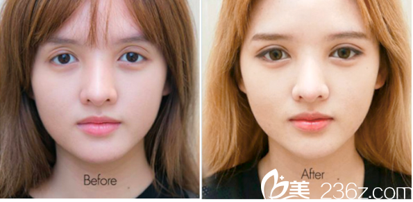 泰國(guó)曼谷F CLINIC醫(yī)美診所薩拉同雙眼皮失敗修復(fù)案例