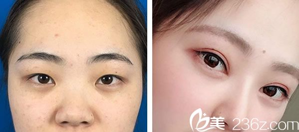 彭素全切雙眼皮+耳軟骨隆鼻效果對比圖