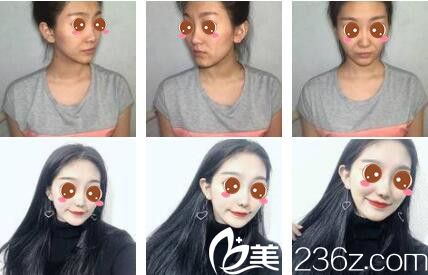 香港美生堂醫(yī)學(xué)美容林醫(yī)生第二代童顏針注射真人案例