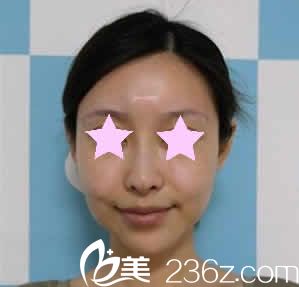 我在南寧華美整形做全臉線雕提升前的照片 我在南寧華美整形做全臉線雕提升前的照片