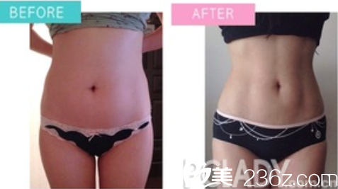 尼斯腰腹部吸脂 尼斯腰腹部吸脂