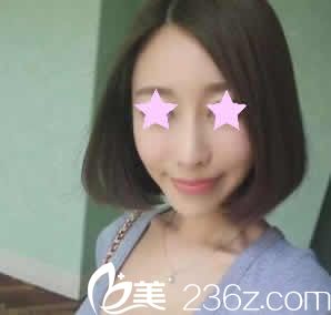南寧華美整形劉真俊院長給我做線雕提升后第5天照片 南寧華美整形劉真俊院長給我做線雕提升后第5天照片