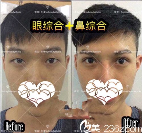 眼綜合手術(shù)案例展示