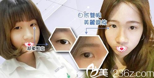 高義盛院長做雙眼皮案例