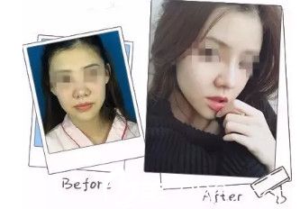 風(fēng)華整形外科診所院長高義盛做自體肋軟骨隆鼻案例