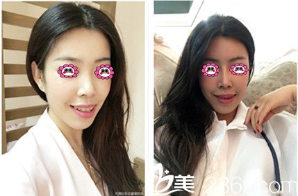 泰國Preecha美容研究所（PAI）隆鼻前后對比照