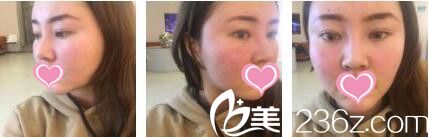 香港美生堂醫(yī)學(xué)美容中心林醫(yī)生面部埋線提升真人案例術(shù)前照 香港美生堂醫(yī)學(xué)美容中心林醫(yī)生面部埋線提升真人案例術(shù)前照