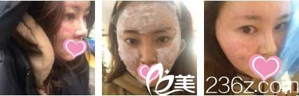 香港美生堂醫(yī)學(xué)美容中心林醫(yī)生面部埋線提升真人案例術(shù)后天 香港美生堂醫(yī)學(xué)美容中心林醫(yī)生面部埋線提升真人案例術(shù)后天