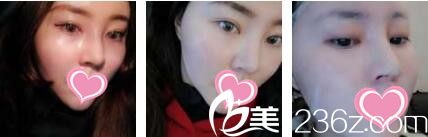 香港美生堂醫(yī)學(xué)美容中心林醫(yī)生面部埋線提升真人案例術(shù)后第七天 香港美生堂醫(yī)學(xué)美容中心林醫(yī)生面部埋線提升真人案例術(shù)后第七天