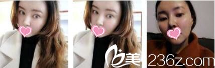 香港美生堂醫(yī)學(xué)美容中心林醫(yī)生面部埋線提升真人案例術(shù)后十五天 香港美生堂醫(yī)學(xué)美容中心林醫(yī)生面部埋線提升真人案例術(shù)后十五天