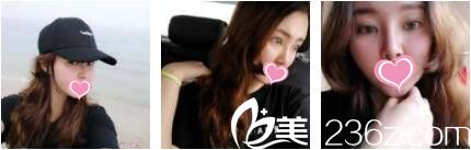 香港哪家醫(yī)院做線雕靠譜？二十八天前我在香港美生堂做了面部埋線提升現(xiàn)在給大家看看效果圖