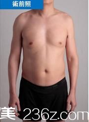 咖蒙整形醫(yī)院威塑4D手術(shù)前 咖蒙整形醫(yī)院威塑4D手術(shù)前