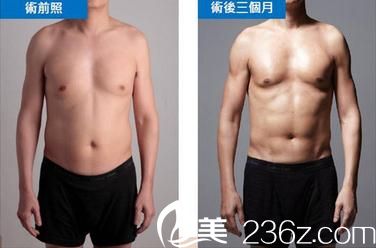 威塑4D脂肪雕刻技術(shù)手術(shù)前后對(duì)比照片 威塑4D脂肪雕刻技術(shù)手術(shù)前后對(duì)比照片