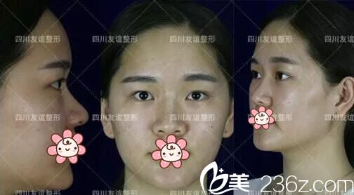 四川友誼醫(yī)院整形美容科雷蕾術(shù)前照片1