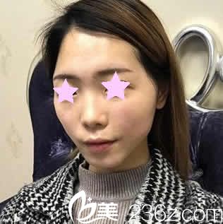 我在南寧東方整形做自體脂肪填充前的照片 我在南寧東方整形做自體脂肪填充前的照片