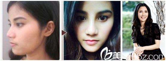 蘇塔尼西品普拉尼膨體隆鼻案例 蘇塔尼西品普拉尼膨體隆鼻案例