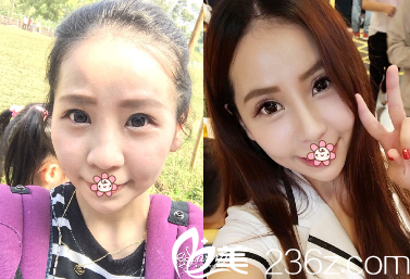 中國(guó)臺(tái)灣星和醫(yī)療玻尿酸隆鼻案例 中國(guó)臺(tái)灣星和醫(yī)療玻尿酸隆鼻案例