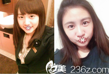 中國(guó)臺(tái)灣星和醫(yī)療雙眼皮案例 中國(guó)臺(tái)灣星和醫(yī)療雙眼皮案例