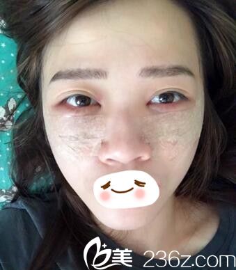 祛眼袋術(shù)當(dāng)天照