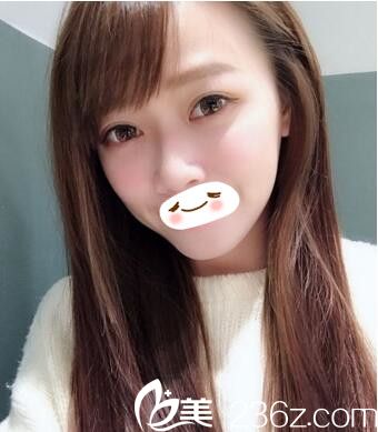 找臺中菲仕美診所林孟羲做內(nèi)切祛眼袋手術后困擾了我多年的眼袋終于消失無蹤了！